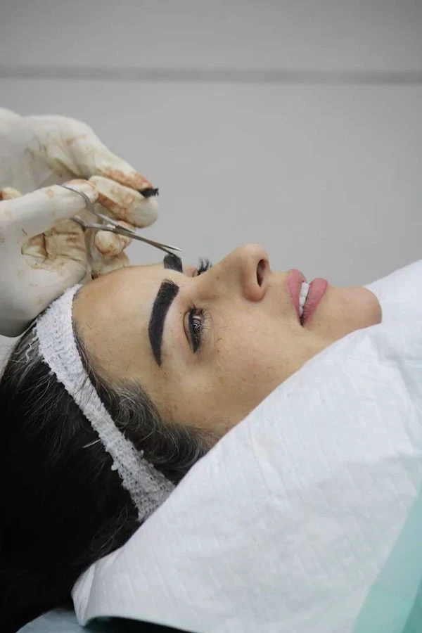 چند روز بعد از کاشت ابرو میریزد؟ | همه چیز درباره ریزش بعد از کاشت تا 12 ماه 17 Hair loss after eyebrow transplantation 15