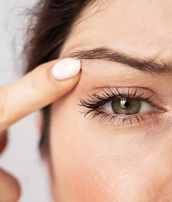 چند روز بعد از کاشت ابرو میریزد؟ | همه چیز درباره ریزش بعد از کاشت تا 12 ماه 8 Hair loss after eyebrow transplantation 7