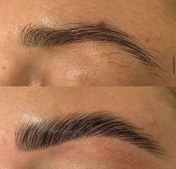 Eyebrow lift with thread 1