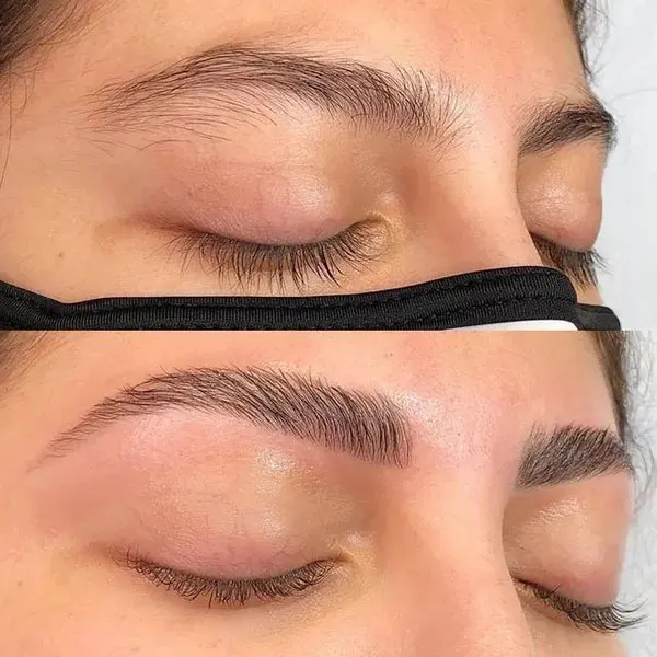 Eyebrow lift with thread 16