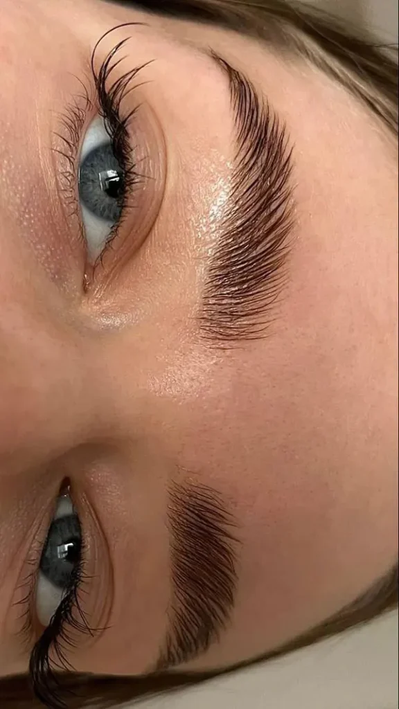 Eyebrow lift with thread 24