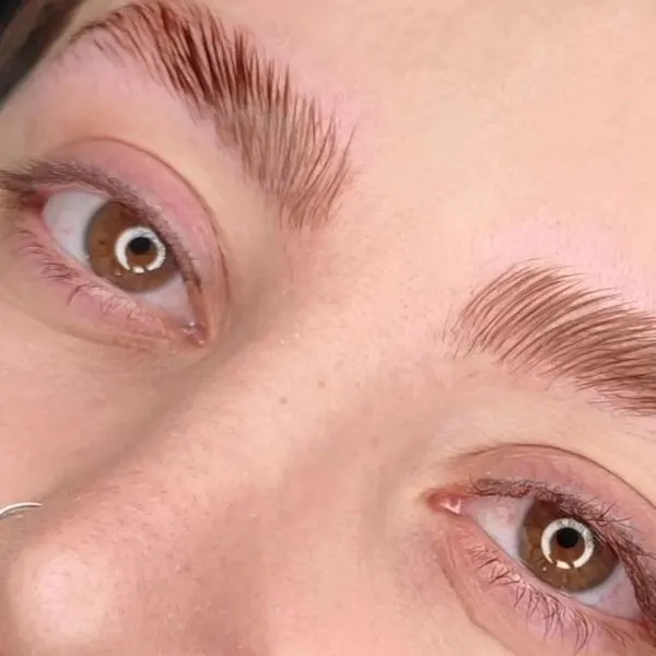 Eyebrow lift with thread 3
