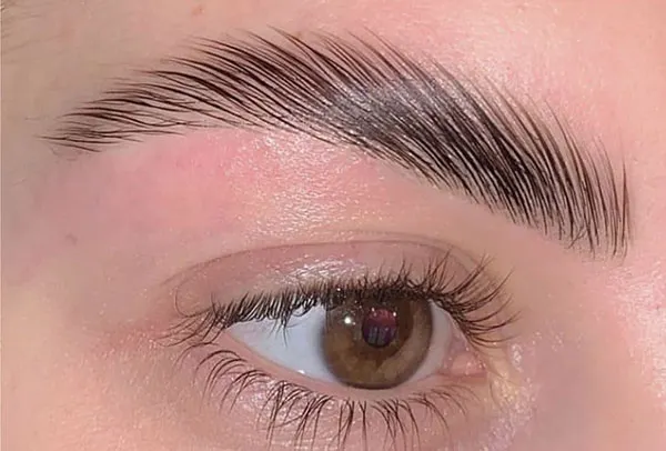 Eyebrow lift with thread 5